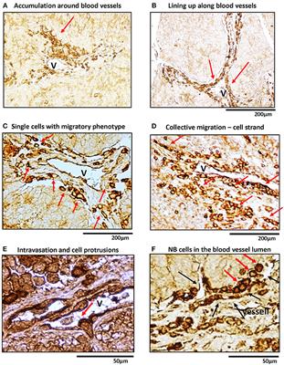 Neuropeptide Y/Y5 Receptor Pathway Stimulates Neuroblastoma Cell Motility Through RhoA Activation